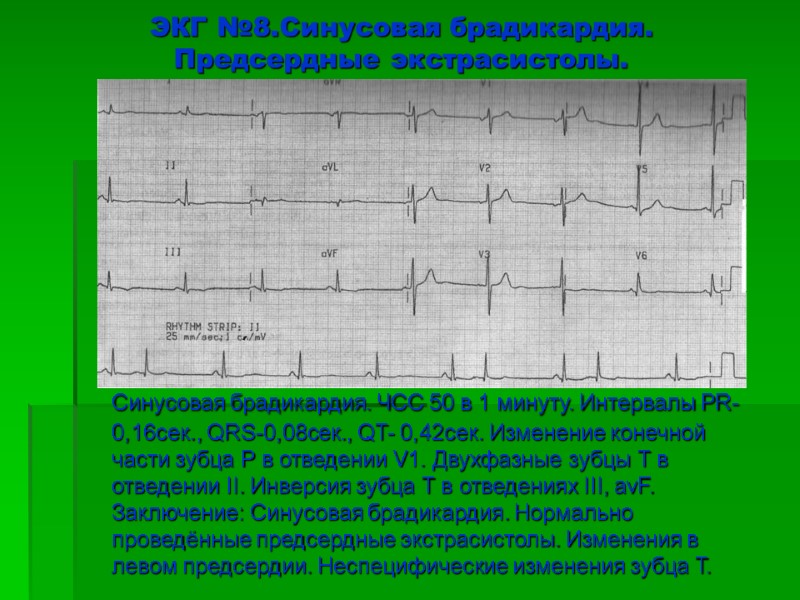 ЭКГ №8.Синусовая брадикардия. Предсердные экстрасистолы.         Синусовая